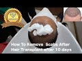 How To Remove Scabs After Hair Transplant after 10 days