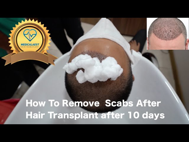 How To Remove Scabs After Hair Transplant after 10 days - YouTube