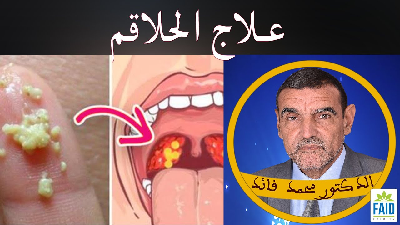 علاج التهاب اللوزتين | الدكتور الفايد