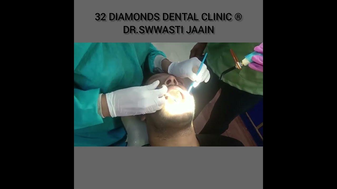 Teeth Filling / Restoration of tooth at 32 DIAMONDS DENTAL CLINIC YouTube