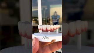 Creating All On 6 Implants Perfection