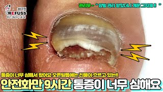 물류창고에서 안전화만 9시간 신어서... 통증이 너무 심하고 진물도 나요ㅠㅠ!! #레푸스 #refuss #내성발톱 #무좀발톱 #발톱 #toenail #발톱무좀 #멍든발톱