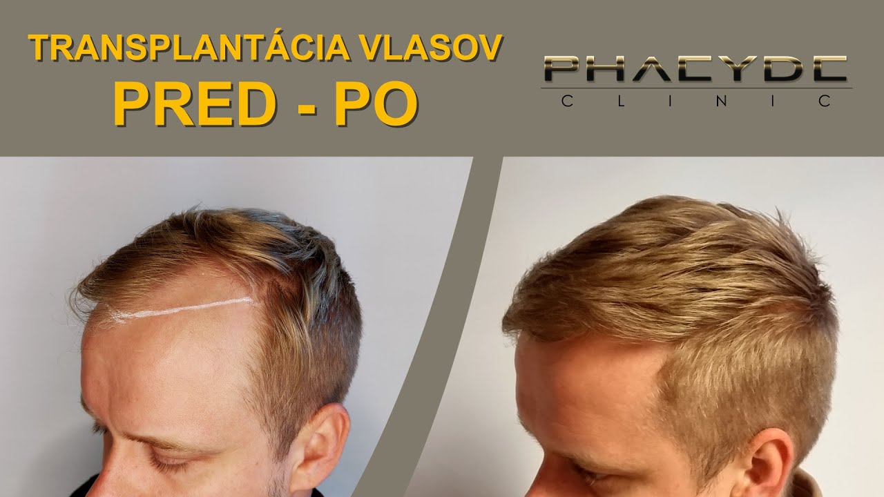 Transplantácia vlasov pred po: Peter (Časozberné video) - PHAEYDE Clinic Bratislava