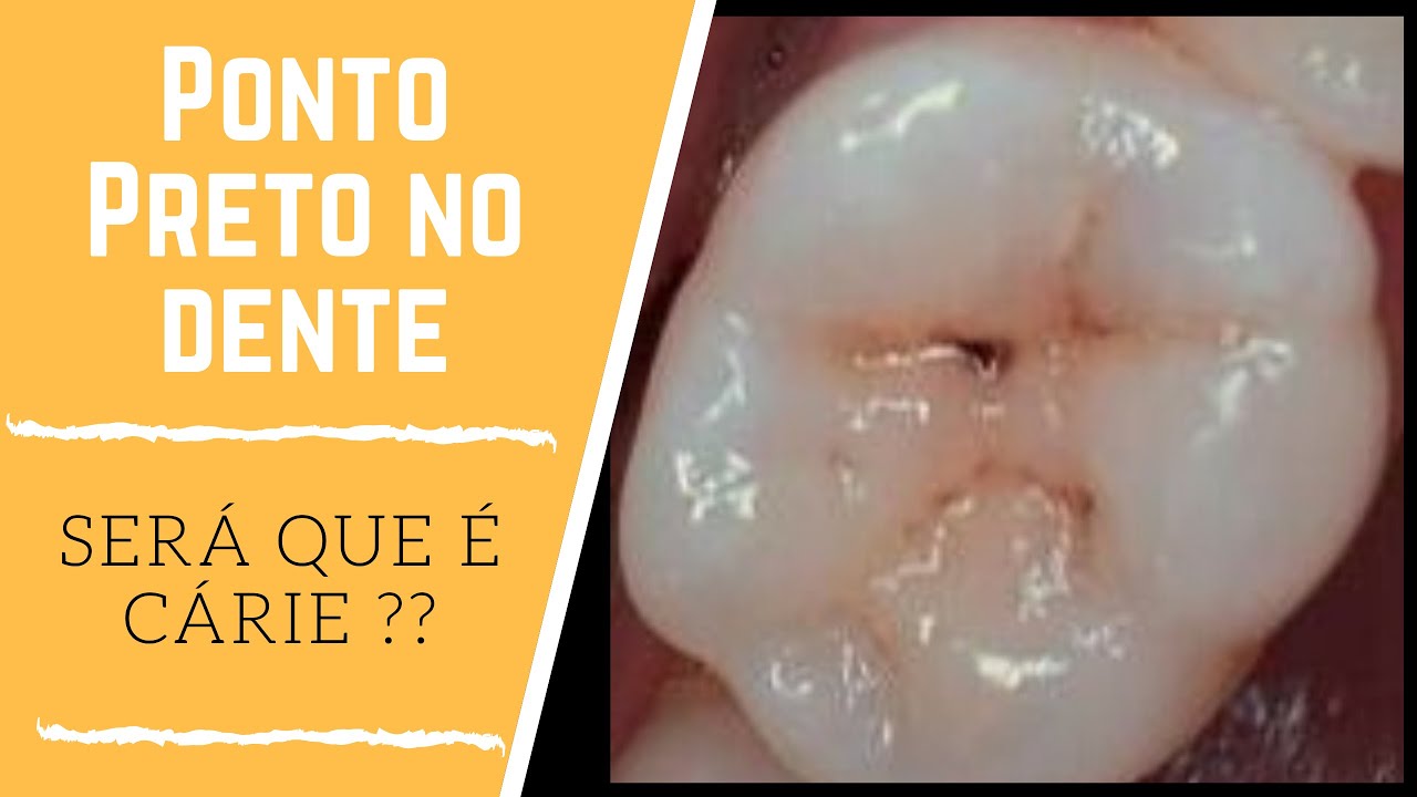 Ponto Preto no Dente - Será uma Cárie ? - YouTube