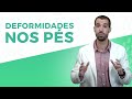 DEFORMIDADES NOS PÉS: COMO EVITAR | Pés Sem Dor