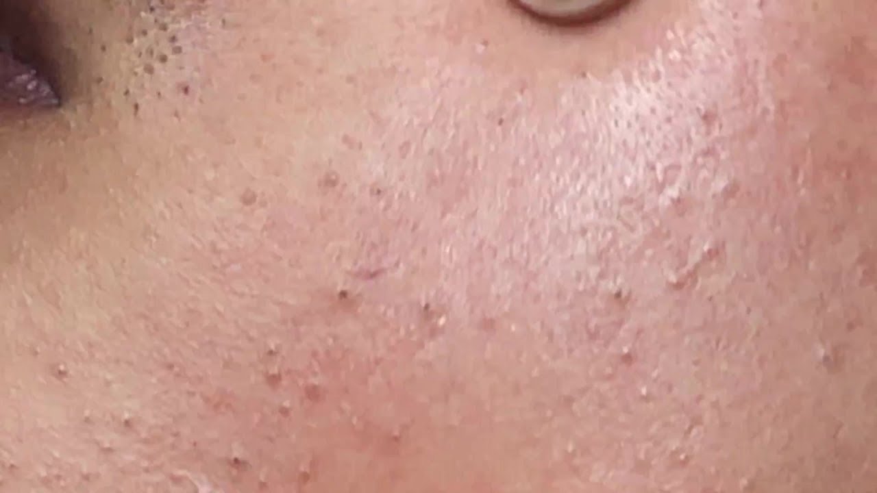Mụn Đầu Đen Chưa Bao Giờ Hết Hot |  Squeeze Blackheads