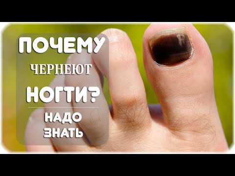 Как и почему чернеют ногти на ногах?