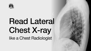 How to Read a Lateral Chest X-Ray