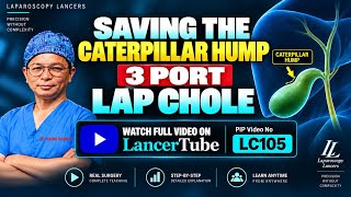 Saving the caterpillar hump - 3 port lap chole, Step by step teaching video 