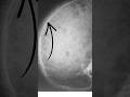 Thalassaemia and Jaundice — When Bones Tell the Story!