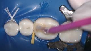Year 3 Class II Composite Restoration in Lower 6