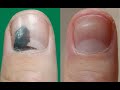 90 days in 40 seconds. Time Lapse Video Of My Nails Healing