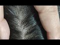 Oddly satisfying dandruff removal 04 02sleepyheads  visual asmr to relax your mind