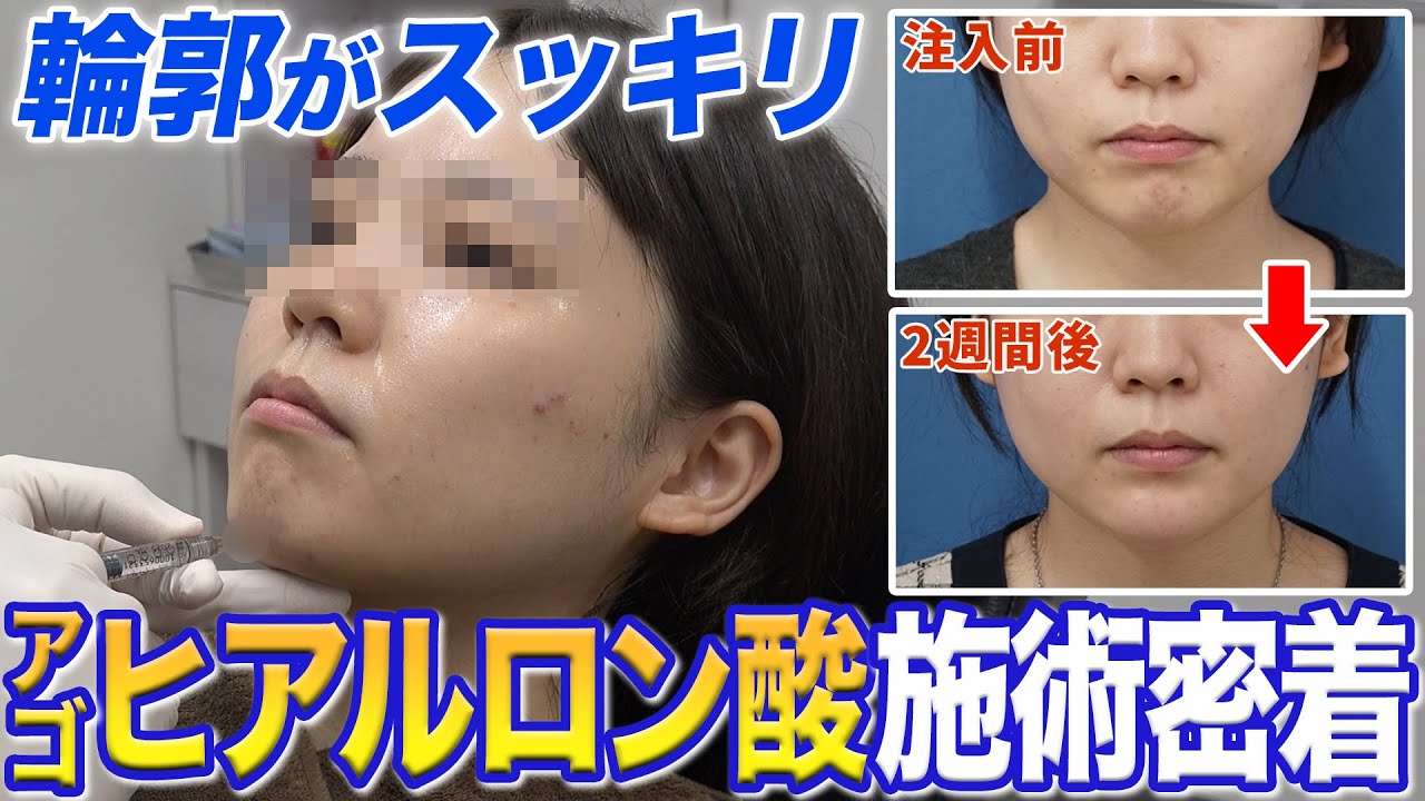 アゴのヒアルロン酸注射の施術を大公開｜フェイスラインがスッキリ整う