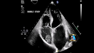 Bubble Test Positive- AVM #shorts