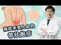 【帶狀皰疹疫苗】蔡文嘉醫師-成大e學堂