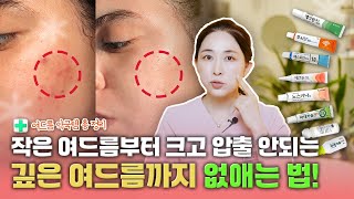 여드름 없애는 약국 연고 추천 총정리!