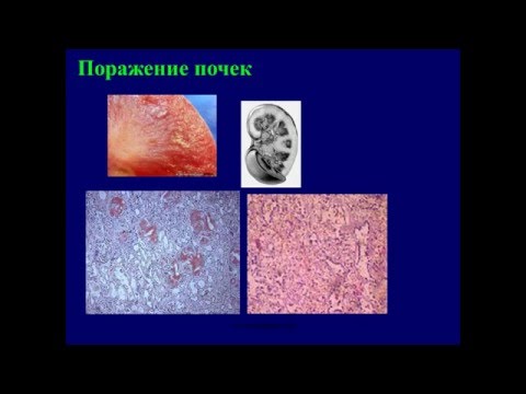 Миеломная болезнь болезнь Рустицкого Калера