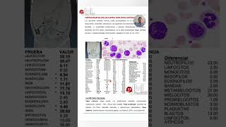 # 2- HEMOGRAMA Y FSP EN LMC. #hematologia #medicina