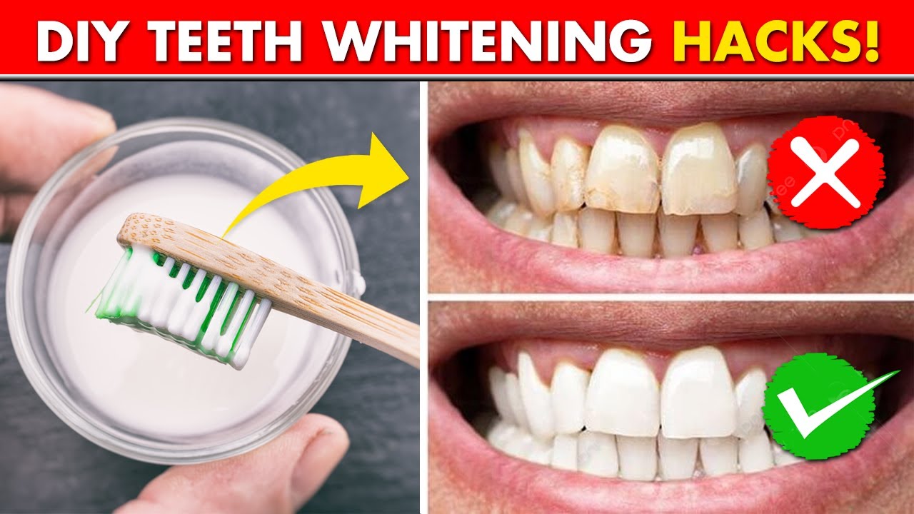 Teeth whitening and scaling tips at homes How to treat yellow teeth