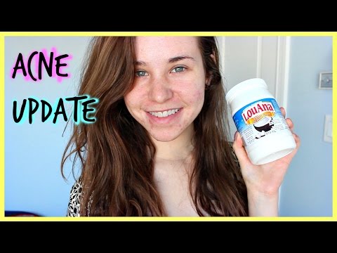 Acne Update: Acne Scars, Skin Care Routine for Acne, Derma roller, Coconut Oil, Diet