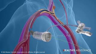 Healthis TAVI Tранскатетерная Имплантация Аортального Клапана