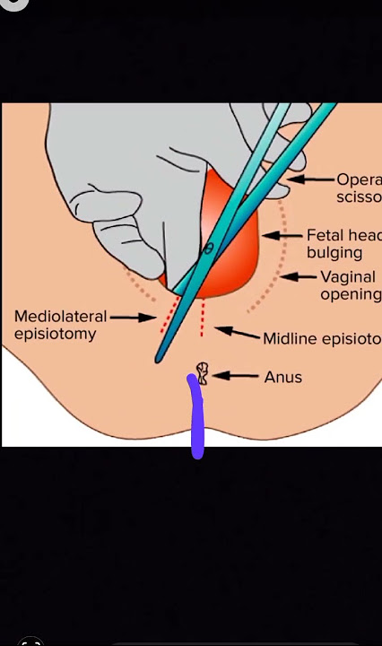 Obstetrics Episiotomy types viva