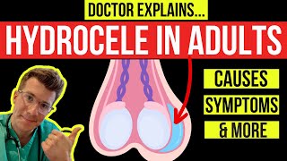 What is a HYDROCELE? Doctor explains causes, symptoms and treatment  (including surgery) - YouTube