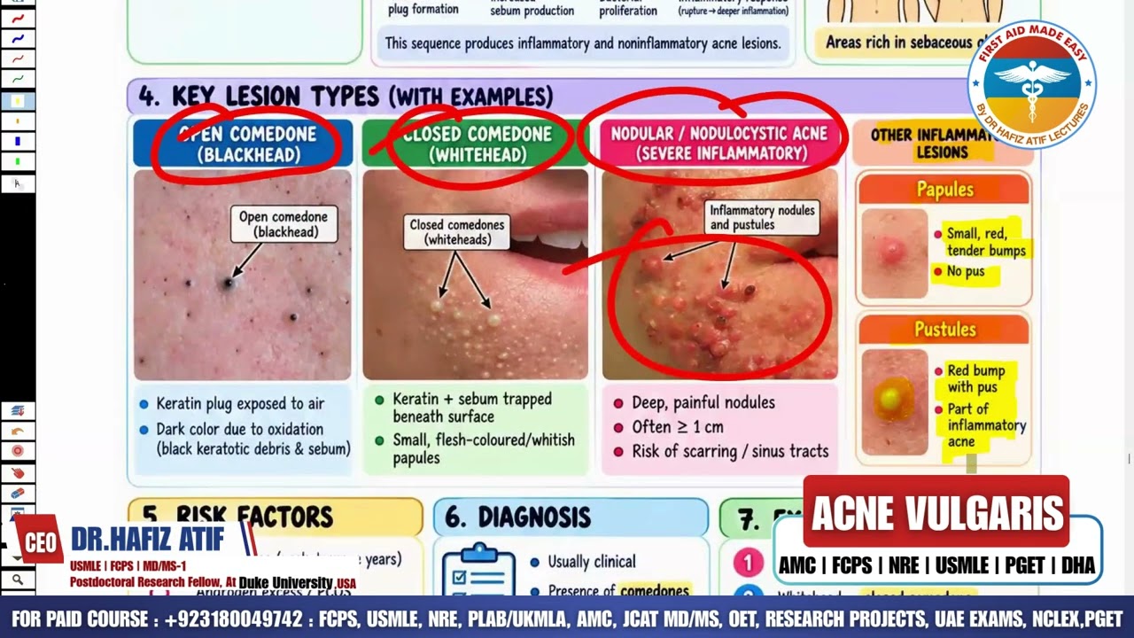 ACNE VULGARIS | Rapid Revision | High-Yield for AMC | FCPS | NRE | USMLE | PGET | DHA |Dr Hafiz Atif