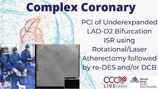 PCI of Underexpanded LAD-D2 Bifurcation ISR by Rotational/Laser Atherectomy then re-DES and/or DCB