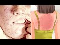 Should You Be Worried About Monkeypox?