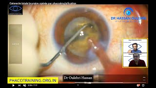 Reviewed Video Phacotraining.org.in : Submission by Dr Oulehri