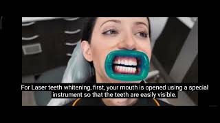 Laser Teeth whitening Procedure(लेजर से दांत सफेद कैसे होता है)#mithilavlog9376