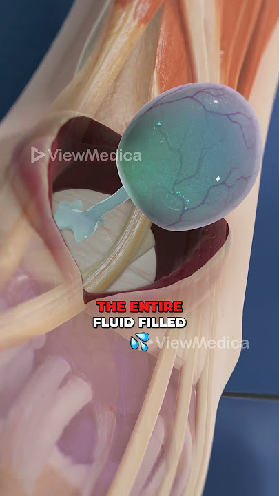 Ganglion Cyst Removal (3D Animation)