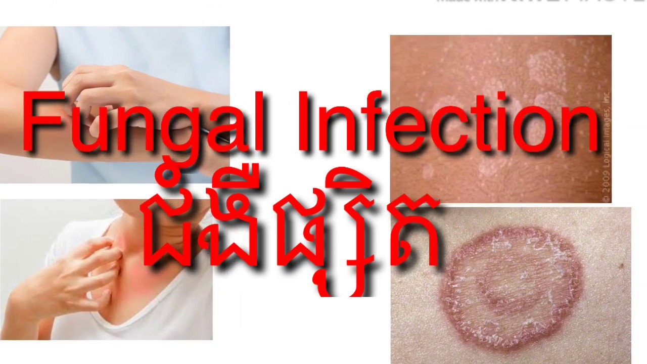 ជំងឺផ្សិតស្បែក នឹងការព្យាបាលដោយប្រេីថ្នាំ Fungal Infection And Treatment By Drug YouTube