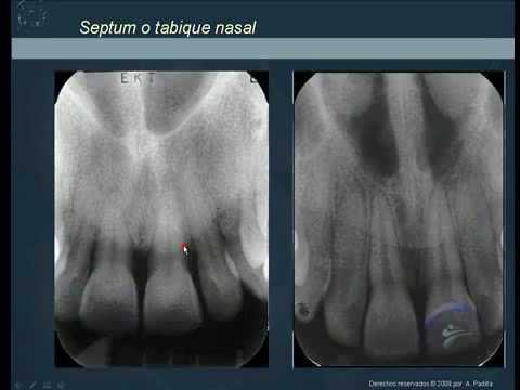 anatomía radiográfica normal 1 normal radiographic anatomy nasal anatomy