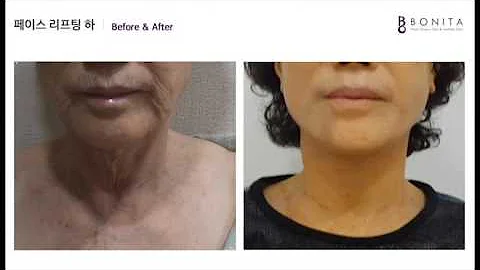 보니따 목주름,처진턱살&볼살,입가주름 팔자주름 리프팅 수술 전후 영상