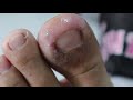 Ep_659 Ingrown nail removal 👣 เศษขึ้ดินไม่เอาออกทำให้เล็บเสียได้นะ 😏 (This clip from Thailand)