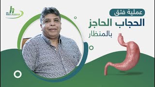 عملية فتق الحجاب الحاجز بالمنظار لعلاج ارتجاع المرئ | الدكتور هادي الاسمر