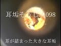 耳垢そうじ/耳が詰まった大きな耳垢/098