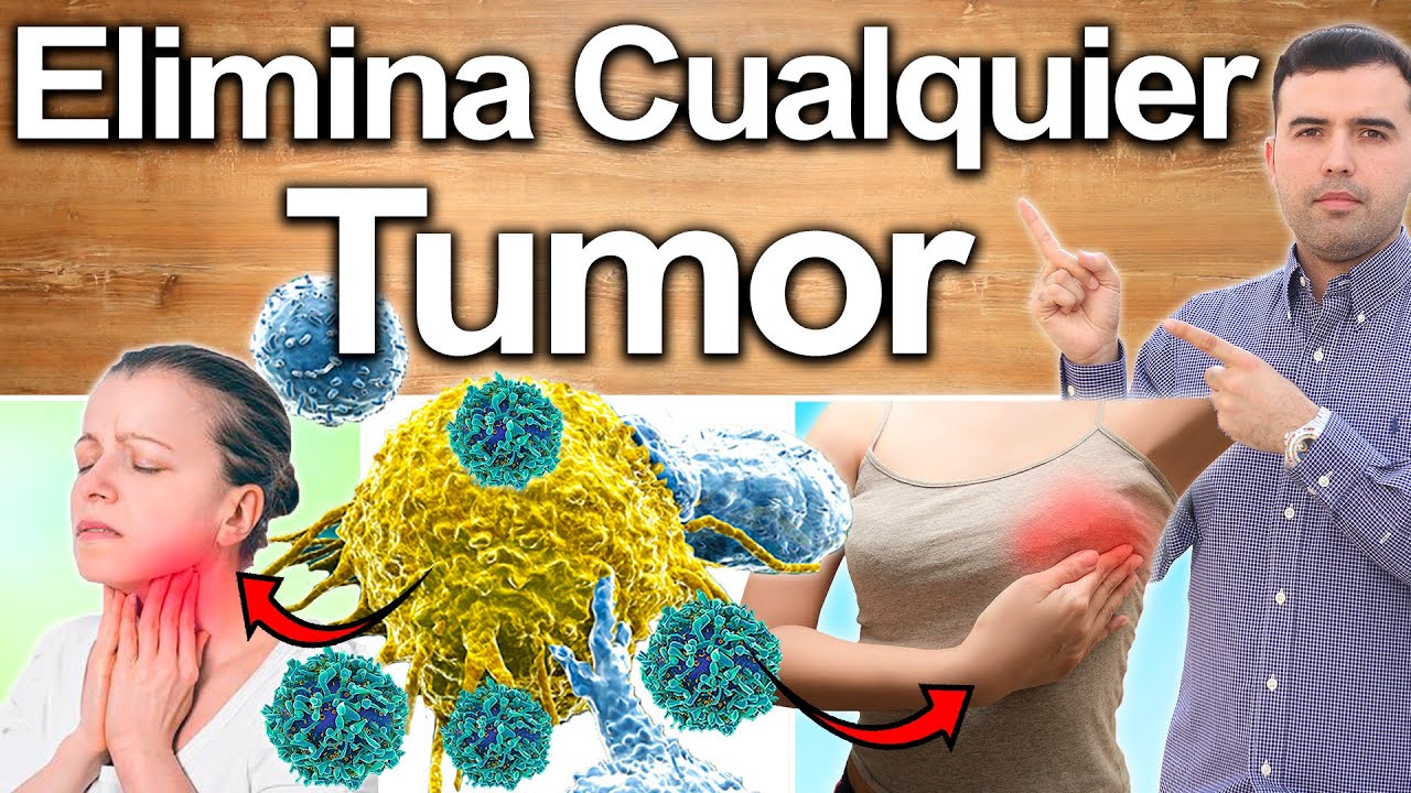 Eliminar Cualquier Tumor O Bola - C�mo Solucionar Tumores, Hernia O Masa En Tu Cuerpo