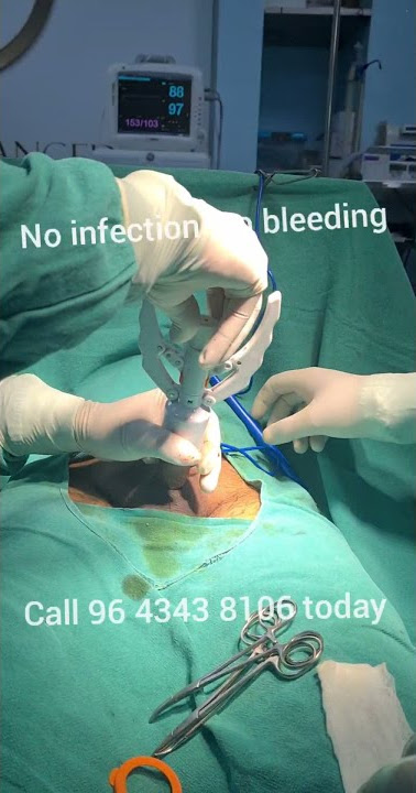 #shorts #zsr stapler circumcision #how I do it