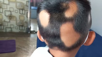 rụng tóc mảng, trụi tóc .người lớn.trẻ em.video cập nhật sau 1 tuần điều trị.