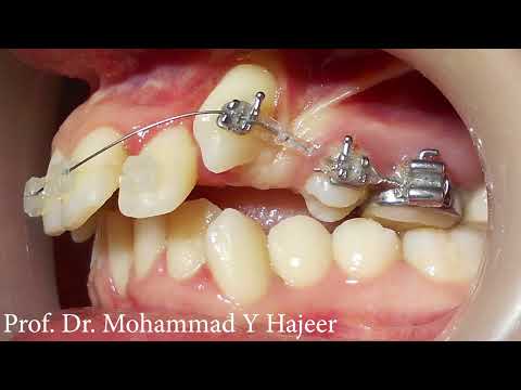 تدبير الأنياب عالية التوضع في طرف واحد من خلال القلع أحادي الجانب الدكتور محمد يونس حجير