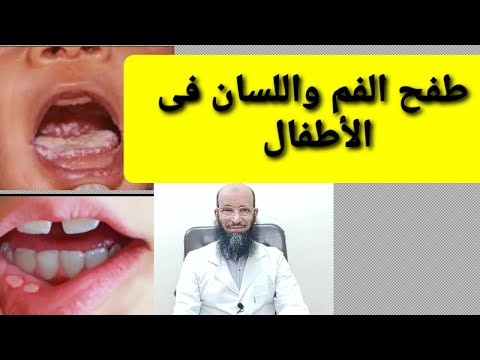 طفح  الفم واللسان فى الأطفال ؛ الأسباب والعلاج