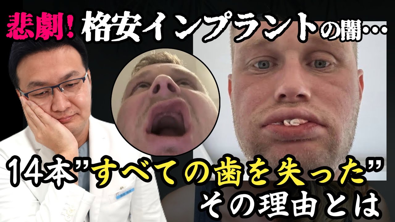 【中古】 こんなにも安いインプラント治療があった 衝撃】激安インプラントの悲劇！実際に起こった悲惨な事例・・・ - YouTube