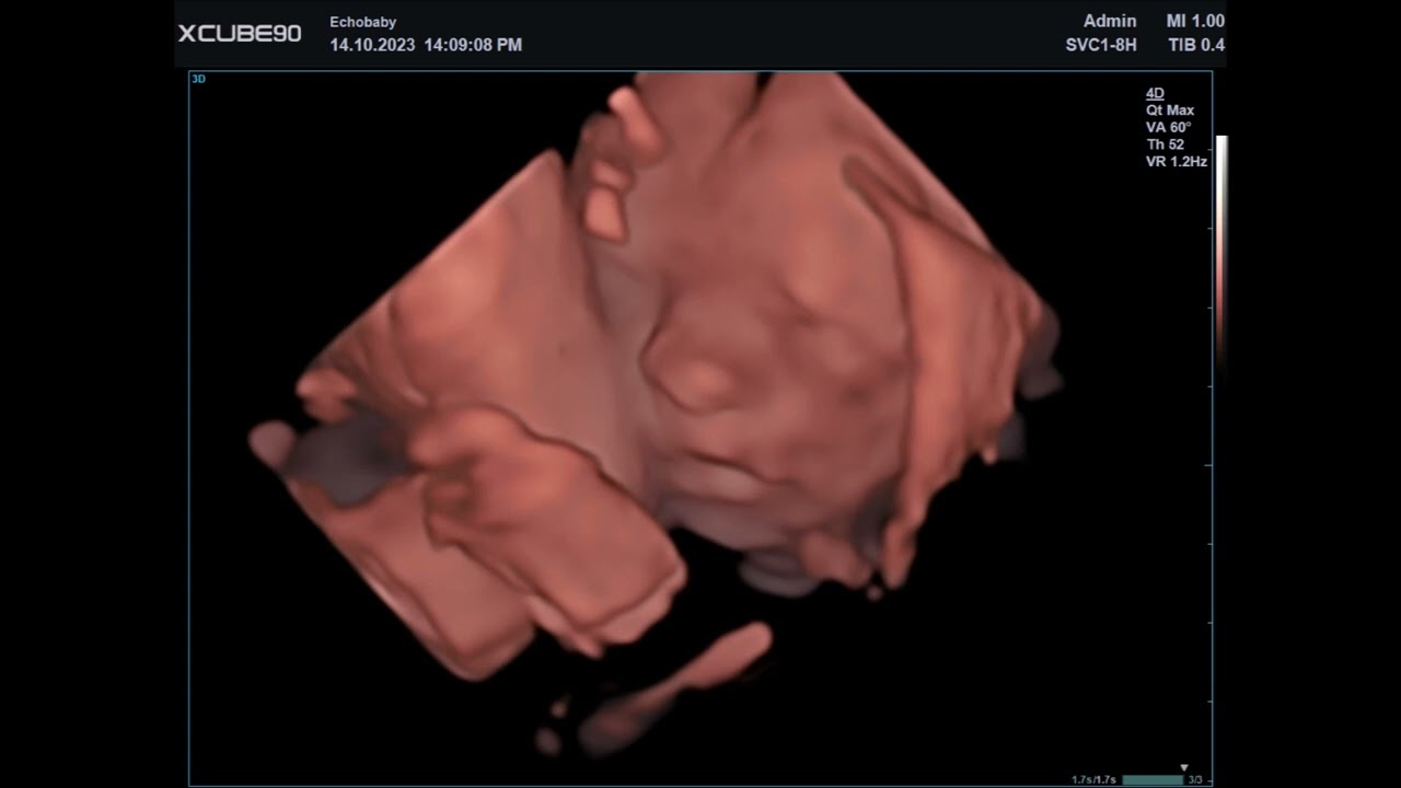 3D Pretecho 23 Weken Zwanger Foto's