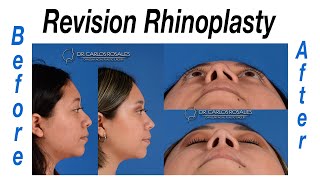 Revision rhinoplasty before and after Resimi