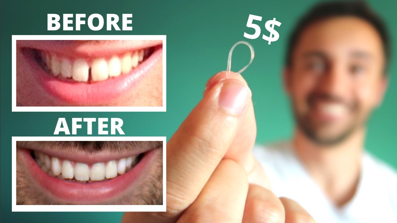 Diy: Close Gap Teeth At Home || My Update