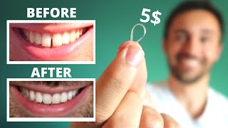 Diy Close Gap Teeth At Home My Update Youtube